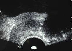 Mann-2 TB in prostate