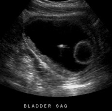 Bladder US sag.jpg