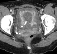 CT Bladder 1.jpg