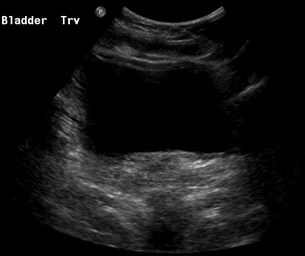 FU Normal Bladder US 5-07.jpg