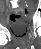 bladder 2.jpg