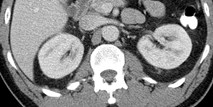 normal kidneys