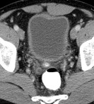 thick bladder, distal R ureter