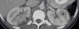 Pyelo-abscesses-3