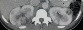 Pyelo-abscess-1