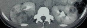 Pyelo-abscess-2