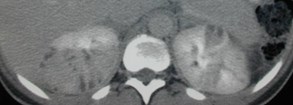 Pyelo-abscess-4