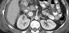 Renal Abscess 1