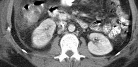 First CT w areas of pyelo