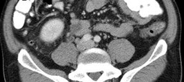 urothelial enhancement prox ureter