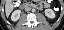 thick enhancing r ureter 1