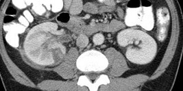 urothelial enhancement
