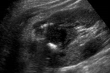 US R kidney trv