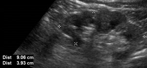 US L kidney sag 1