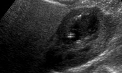 US R kidney sag 1