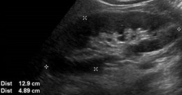 US R kidney sag 2
