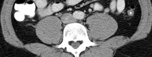 thick enhancing r ureter 2