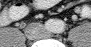 thick enhancing r ureter 2