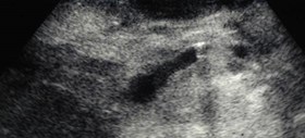 Choi-3 ureter w gas
