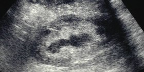 Choi-1 mild L hydro