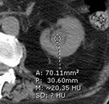 9-2 sepsis, high density hydro 2