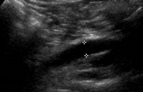 US dilated R ureter