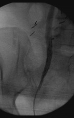 retrograde, smooth tapering ureter