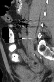 US sag dist R ureter