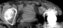 CT 6 high density bladder
