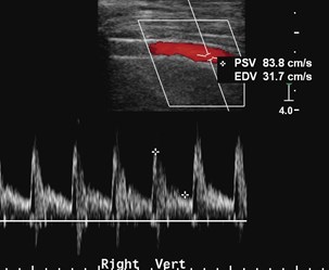 2 pre stent vel.jpg