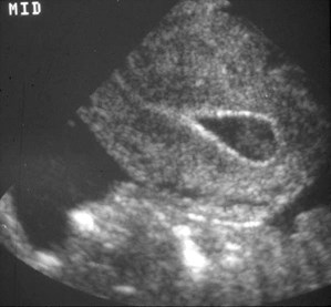ectopic02