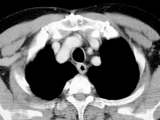 wide sup med vessels CT