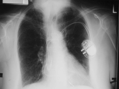 G:\photos\mediastinum\lymphoma of pericardium parkins\pa baseline.jpg