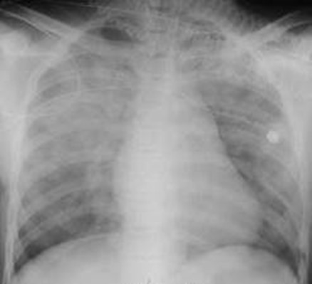 Pulmonary edema-before