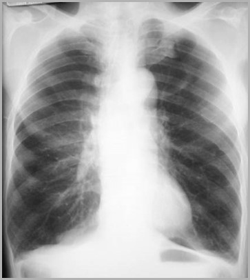 COPD-frontal