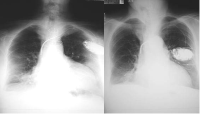 apical lordotic