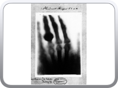 About two weeks later, he exposed the first x-ray of a human which is allegedly of his wife Bertha's hand.