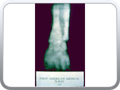 Dr. Edwin Frost (1866-1935) is credited with making the first diagnostic radiograph in the U.S. at Dartmouth on February 3, 1896.