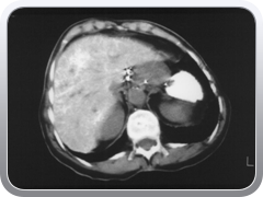 It is estimated that up to 10 million people received Thorotrast. It was a superb contrast agent but it was deposited in the reticuloendothelial system where it essentially remained for the lifetime of the patient delivering its own radiation to the liver, spleen and lymph nodes for decades. 