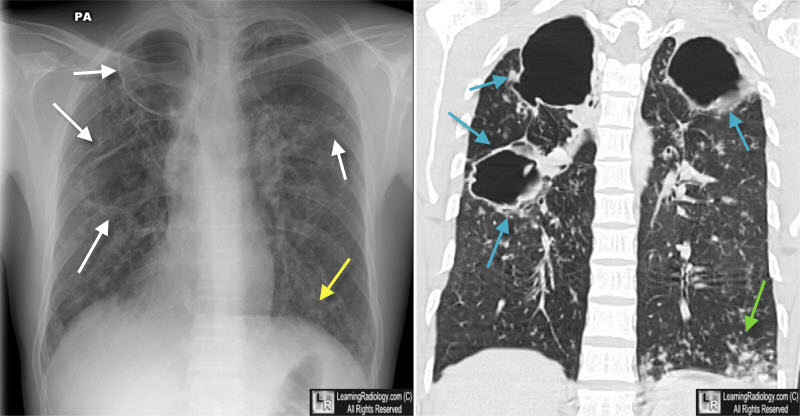 cavitary tb