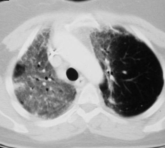 Radiation Pneumonitis