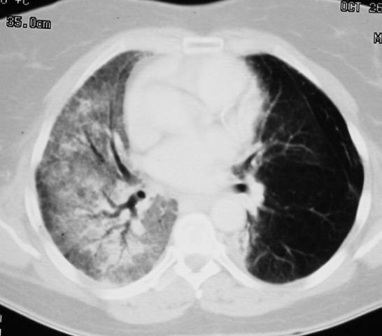 Radiation Pneumonitis