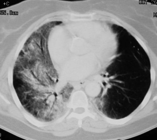 Radiation Pneumonitis