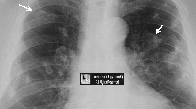 reverse exposure x ray