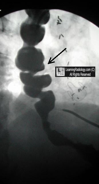 Corkscrew Esophagus, Diffuse Esophageal Spasm