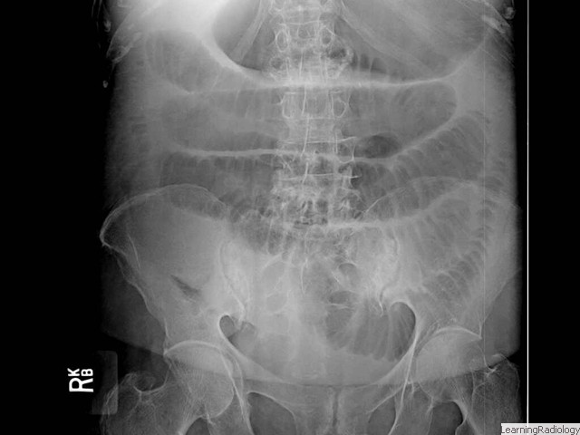 Small bowel Obstruction.