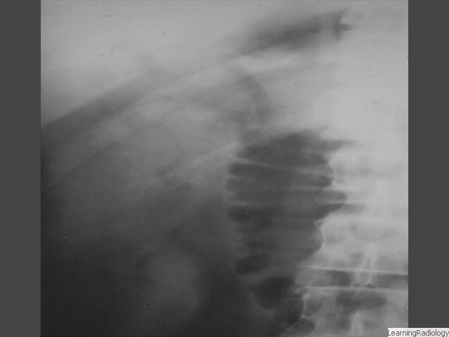 Gallstone Ileus-close-up of right upper quadrant. There is air in the bile ducts from fistula to duodenum that allows gallstone to enter bowel.