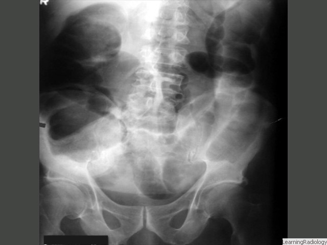 Large Bowel Obstruction. Dilated large bowel down to the level of the sigmoid indicates a distal large bowel obstruction, usually caused by tumor.