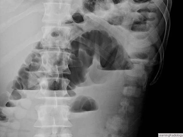 Small Bowel Obstruction-upright view. Multiple air-fluid levels in dilated loops of small bowel, some at different heights in same loop, are seen.