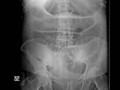 Small bowel Obstruction.